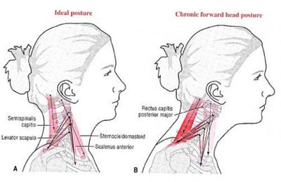 forward head posture